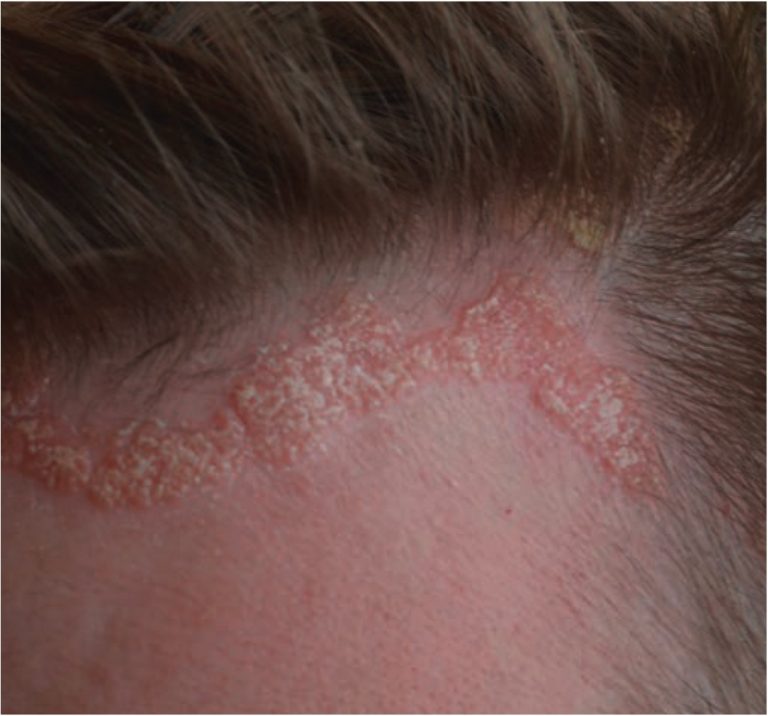 SCALP PSORIASIS: PUNCA DAN CARA RAWATAN JANGKA PENDEK - Faith Fleur